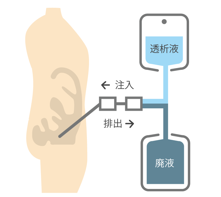 腹膜透析療法