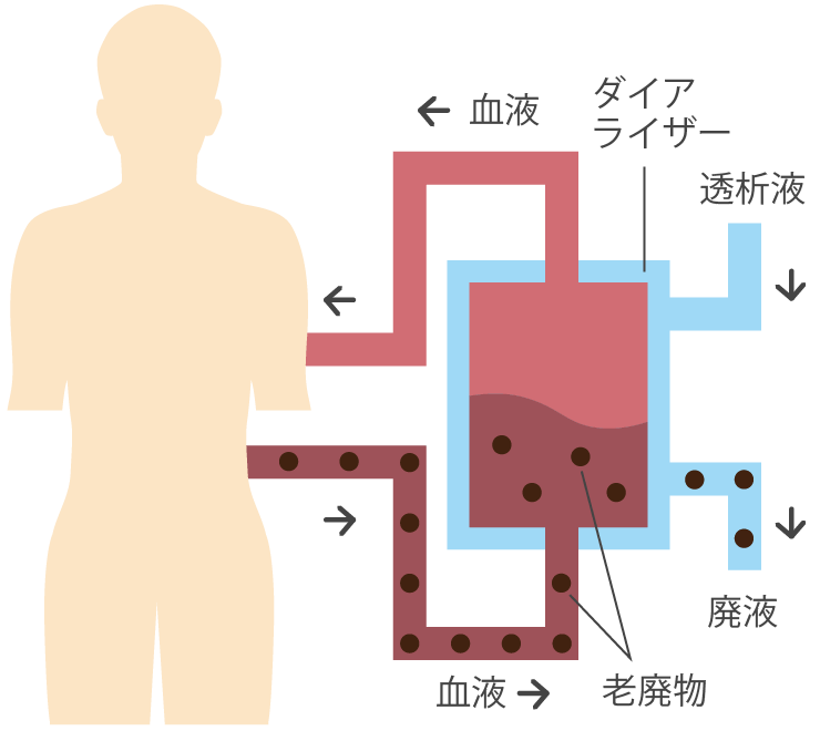 血液透析療法
